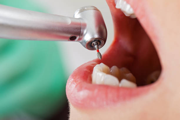 Best Broken or Cracked Tooth Emergency Dentist in Fair Oaks, CA